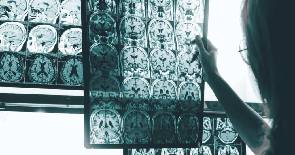 Un índice sobre asimetría cerebral aporta una nueva vía para medir el Alzheimer y alerta de su avance silencioso