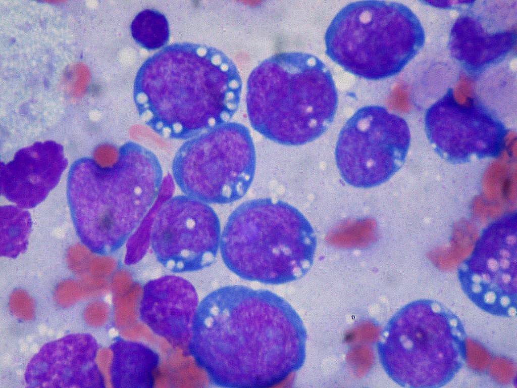 Expertos desmontan las “dietas milagro” contra el cáncer y ponen el foco en un riesgo ya conocido: la obesidad